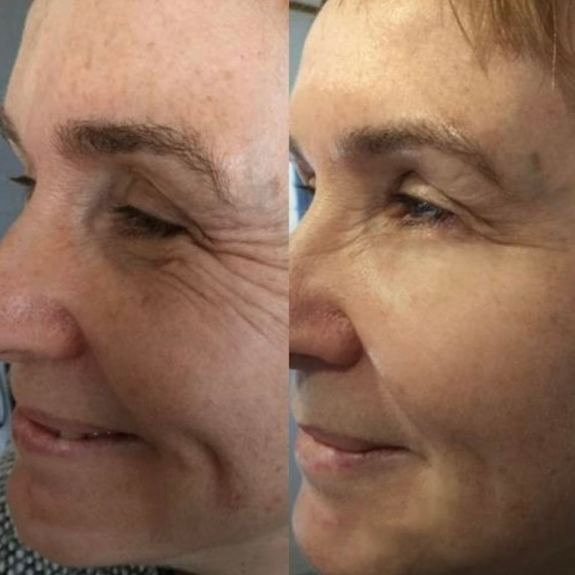 AURALIS™ – Vita-A Retinal Shot
Avancerad hudbehandling